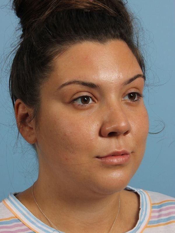 Dermal Fillers Patient Photo - Case 14896 - before view-4