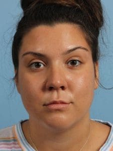 Dermal Fillers - Case 14896 - Before