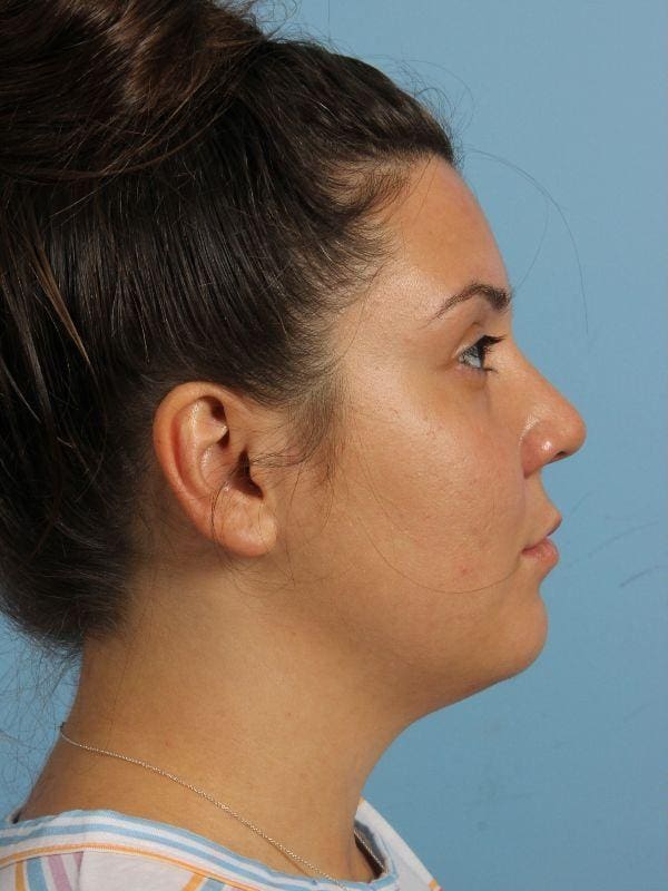 Dermal Fillers Patient Photo - Case 14896 - before view-2