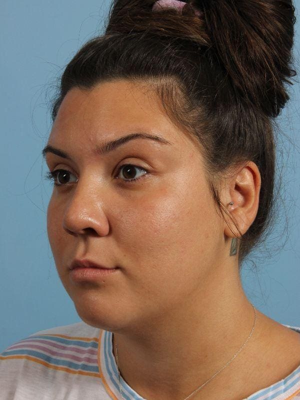 Dermal Fillers Patient Photo - Case 14896 - before view-3