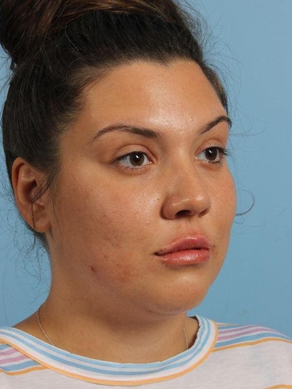 Dermal Fillers Patient Photo - Case 14896 - after view-4