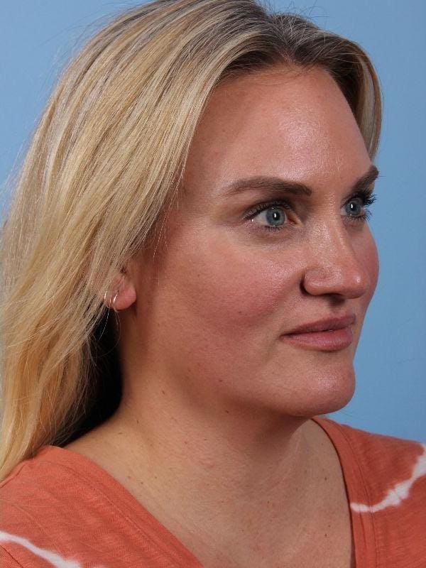 Dermal Fillers Patient Photo - Case 14909 - after view-5