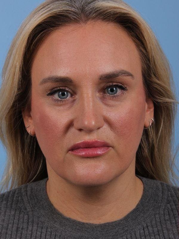 Dermal Fillers Patient Photo - Case 14909 - before view-