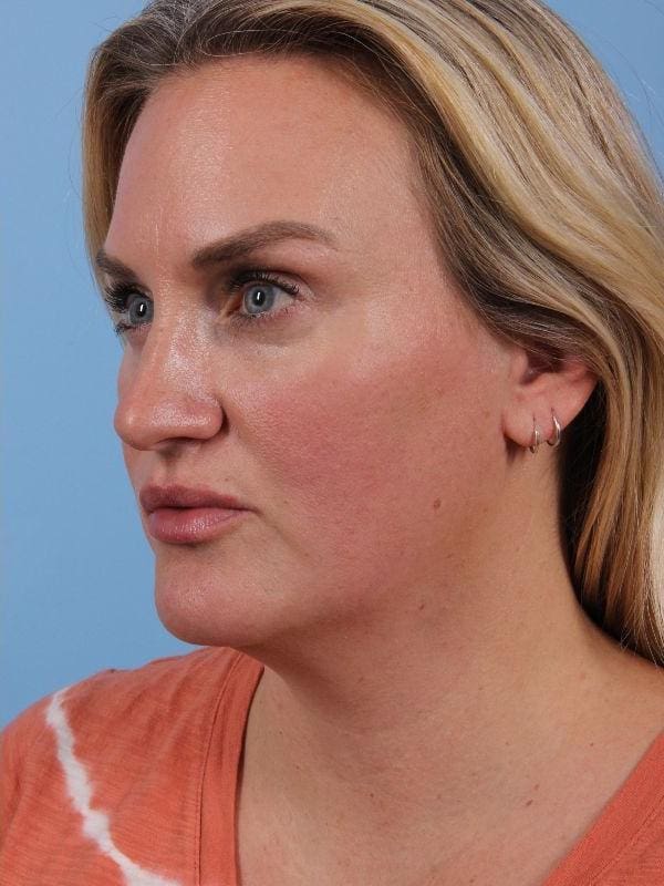 Dermal Fillers Patient Photo - Case 14909 - after view-4