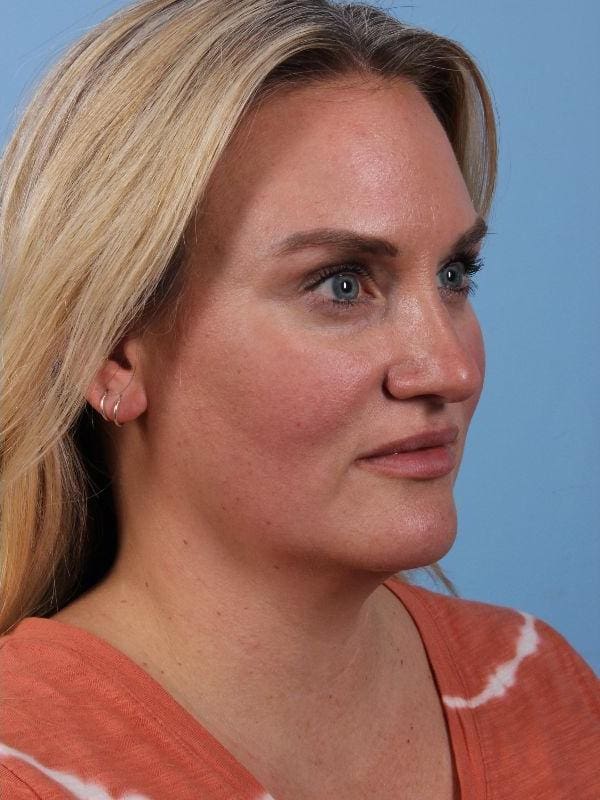 Dermal Fillers Patient Photo - Case 14909 - after view-6