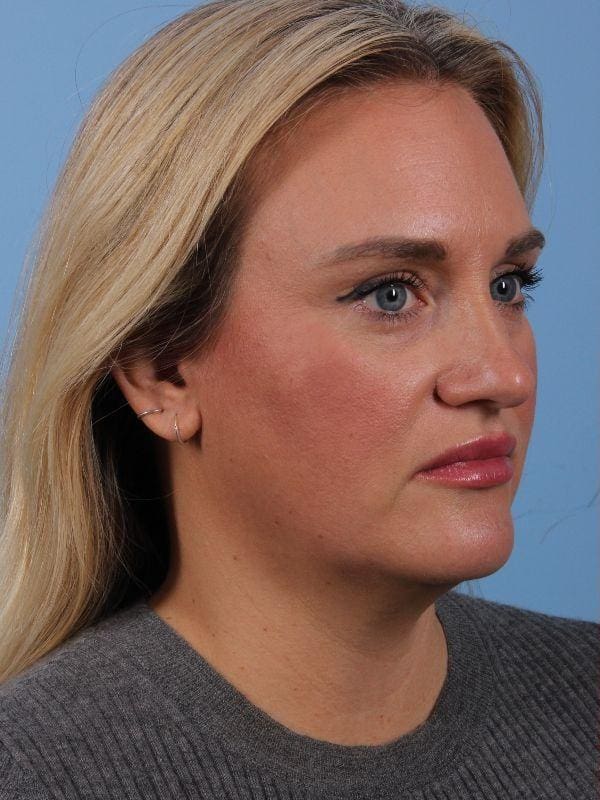 Dermal Fillers Patient Photo - Case 14909 - before view-5
