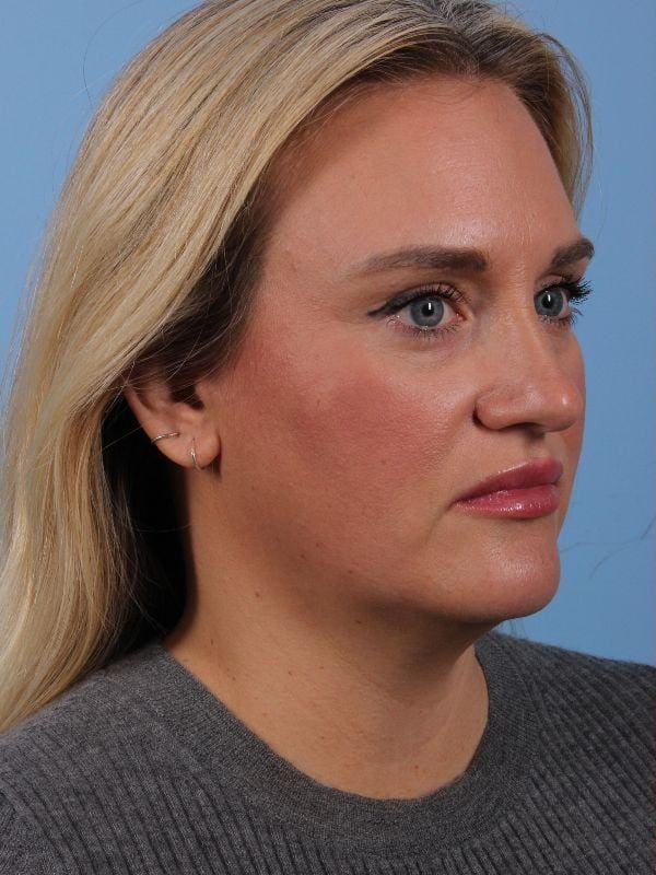 Dermal Fillers Patient Photo - Case 14909 - before view-6