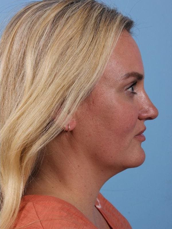 Dermal Fillers Patient Photo - Case 14909 - after view-2