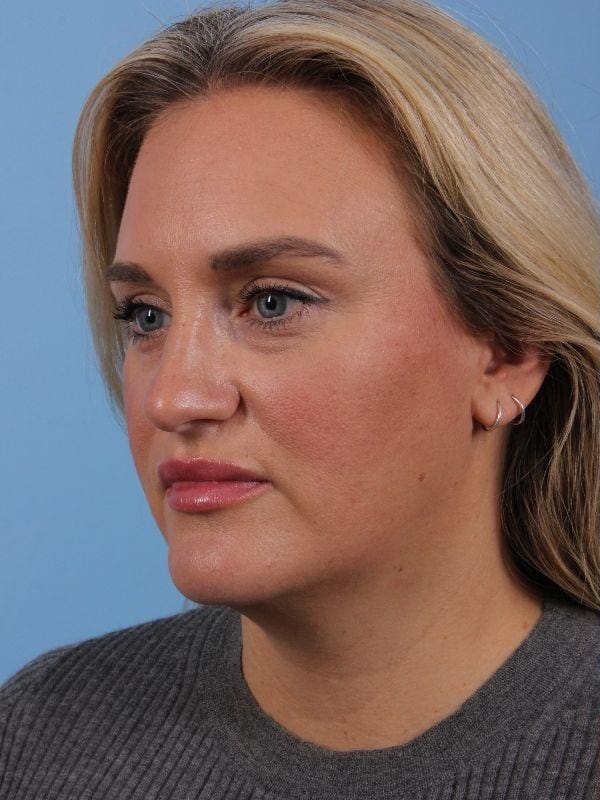 Dermal Fillers Patient Photo - Case 14909 - before view-4