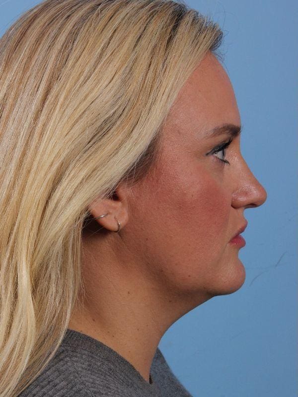 Dermal Fillers Patient Photo - Case 14909 - before view-2