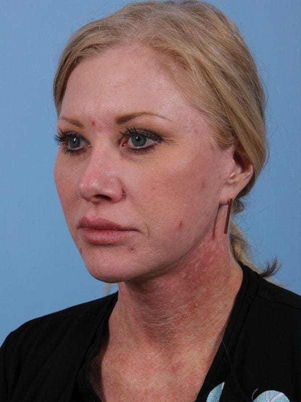 Dermal Fillers Patient Photo - Case 14925 - before view-1