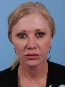 Dermal Fillers - Case 14925 - Before