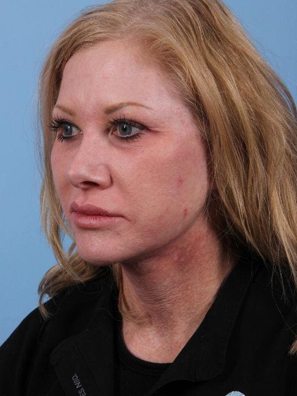 Dermal Fillers Patient Photo - Case 14925 - after view-1