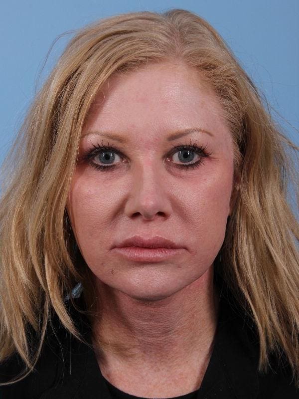 Dermal Fillers Patient Photo - Case 14925 - after view