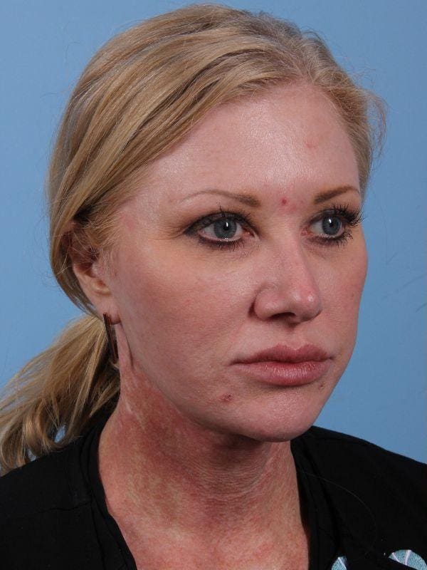 Dermal Fillers Patient Photo - Case 14925 - before view-2