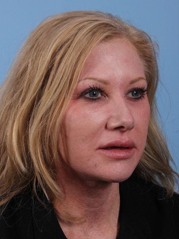 Dermal Fillers Patient Photo - Case 14925 - after view-2