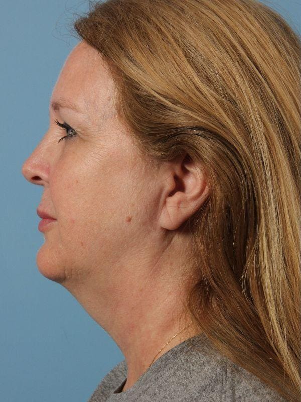 Dermal Fillers Patient Photo - Case 14933 - before view-1
