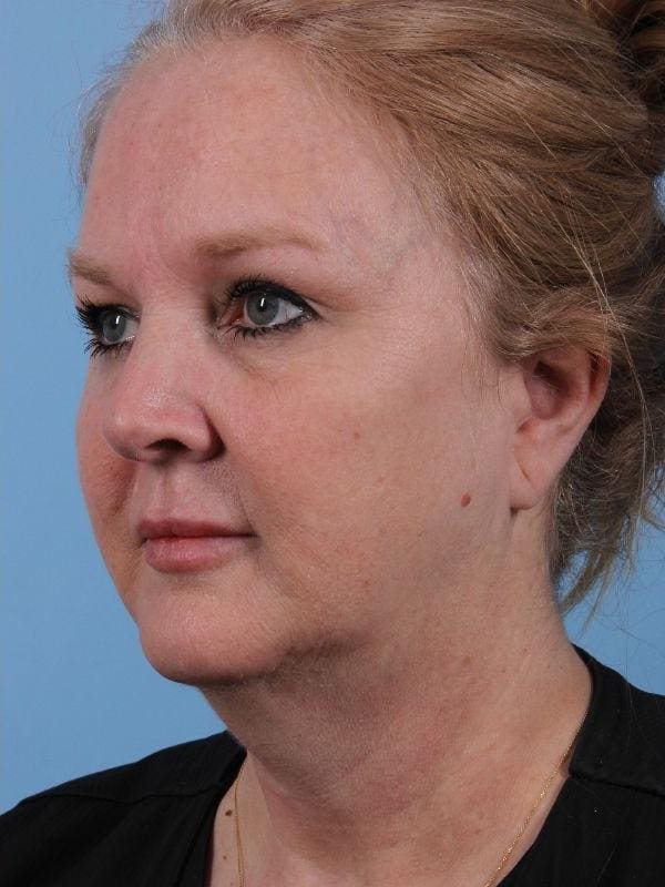 Dermal Fillers Patient Photo - Case 14933 - after view-2
