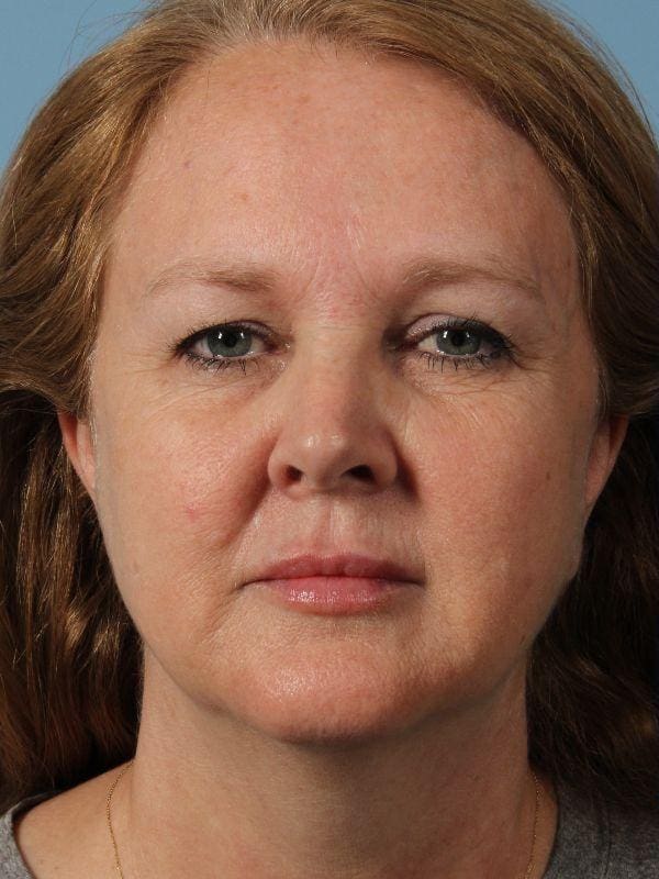 Dermal Fillers Patient Photo - Case 14933 - before view-