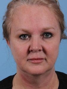 Dermal Fillers - Case 14933 - After