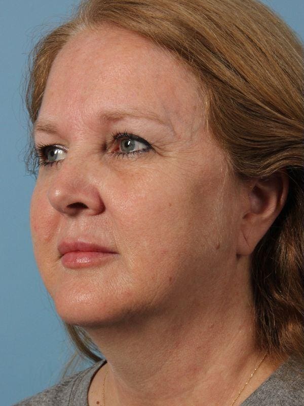 Dermal Fillers Patient Photo - Case 14933 - before view-2