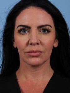 Dermal Fillers - Case 14942 - Before