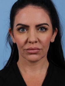 Dermal Fillers - Case 14942 - After