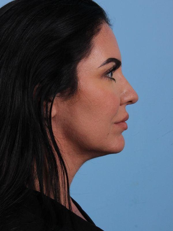Dermal Fillers Patient Photo - Case 14942 - before view-2