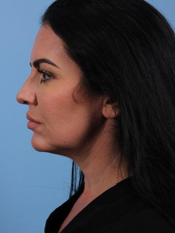 Dermal Fillers Patient Photo - Case 14942 - before view-1