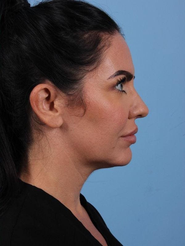 Dermal Fillers Patient Photo - Case 14942 - after view-2