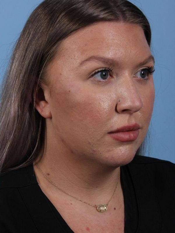 Injectable Fillers Patient Photo - Case 14953 - after view-4