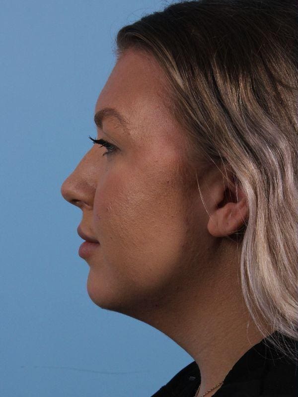 Injectable Fillers Patient Photo - Case 14953 - before view-1