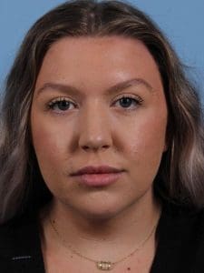 Dermal Fillers - Case 14953 - Before