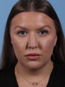 Dermal Fillers - Case 14953 - After