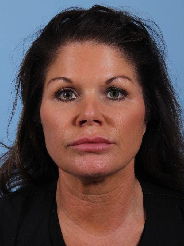 Dermal Fillers Patient Photo - Case 14966 - before view-