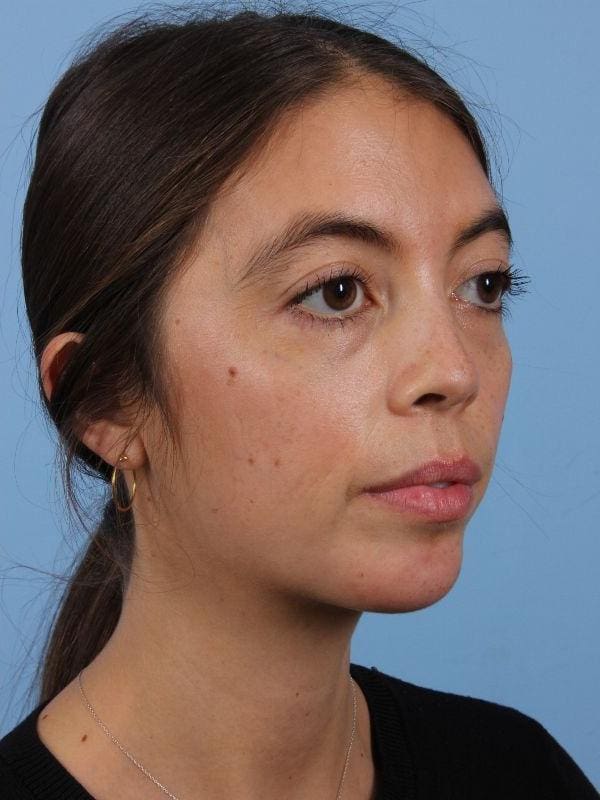 Dermal Fillers Patient Photo - Case 14979 - after view-4