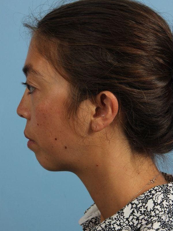 Dermal Fillers Patient Photo - Case 14979 - before view-1