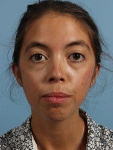Dermal Fillers - Case 14979 - Before