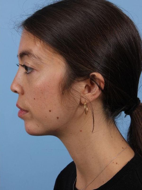 Dermal Fillers Patient Photo - Case 14979 - after view-1