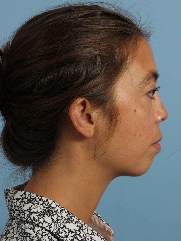 Dermal Fillers Patient Photo - Case 14979 - before view-2