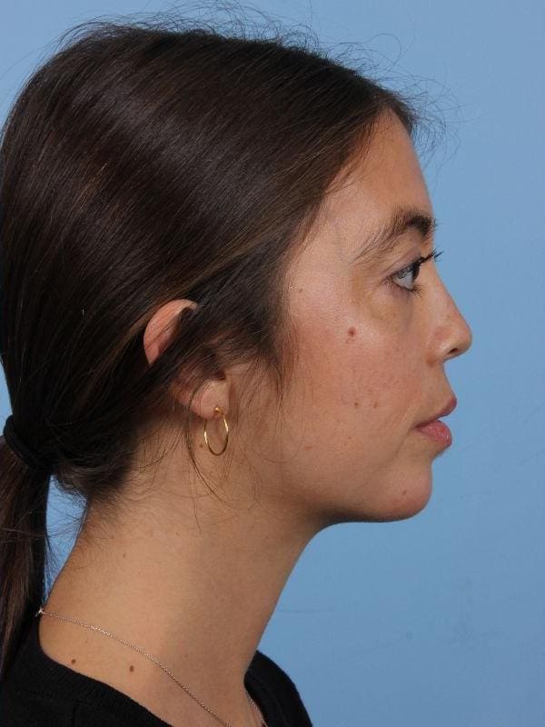 Dermal Fillers Patient Photo - Case 14979 - after view-2