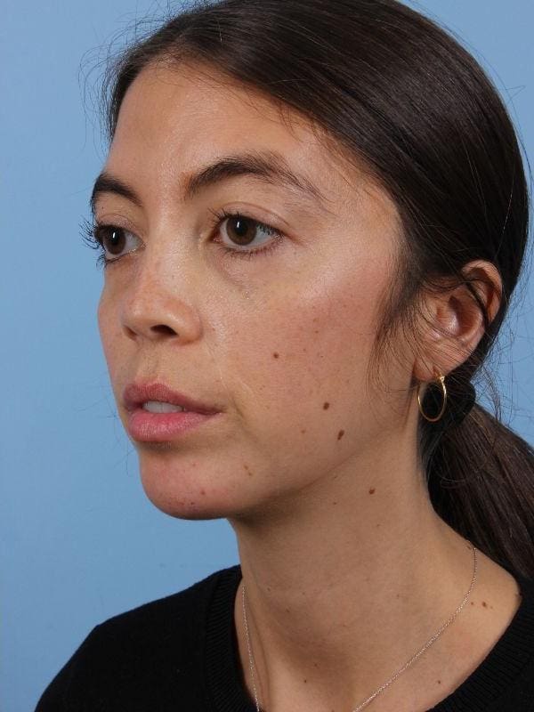 Dermal Fillers Patient Photo - Case 14979 - after view-3