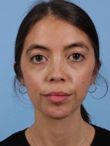 Dermal Fillers - Case 14979 - After