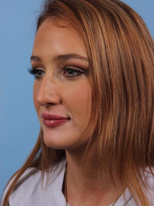 Injectable Fillers Patient Photo - Case 14991 - after view-3