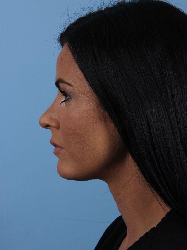 Dermal Fillers Patient Photo - Case 15003 - before view-1