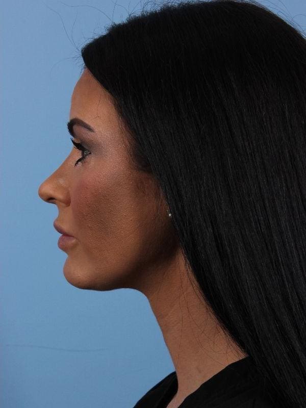 Dermal Fillers Patient Photo - Case 15003 - after view-1
