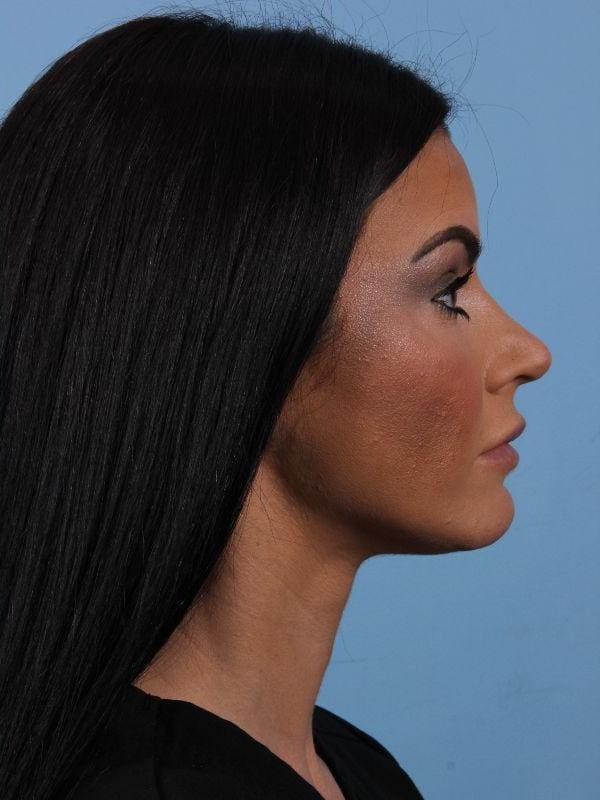 Dermal Fillers Patient Photo - Case 15003 - after view-2