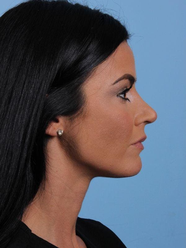 Dermal Fillers Patient Photo - Case 15003 - before view-2
