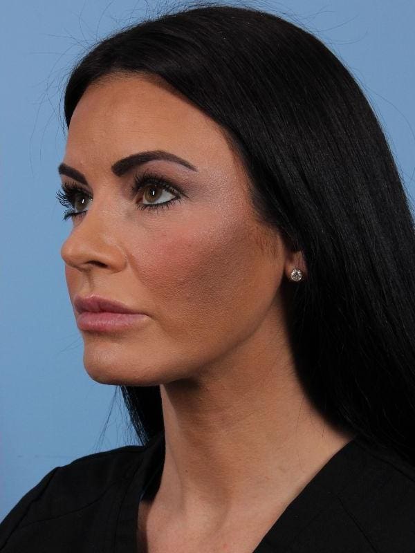 Dermal Fillers Patient Photo - Case 15003 - after view-3