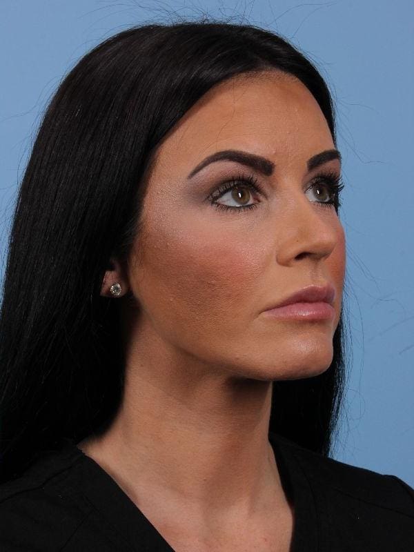 Dermal Fillers Patient Photo - Case 15003 - after view-4